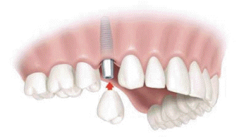 Dental Implants Wantagh
