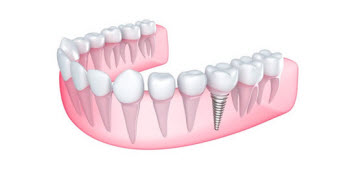 Dental Implants Wantagh