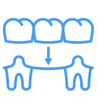 implant bridge